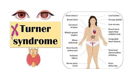 Turner Syndrome Causes, Symptoms, and Management