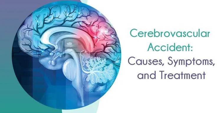 Cerebrovascular Accident (Stroke) Types, Symptoms, Treatment and Prevention